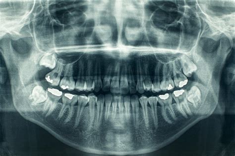insight   categories  extraoral dental  rays diy
