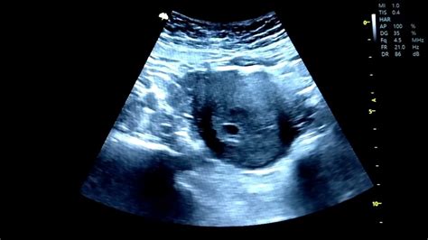Saco Gestacional De 4 6 Semanas De GestaciÓn Embarazo De 4 Semanas