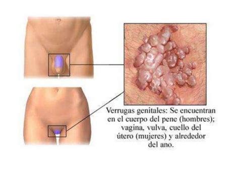 enfermedades de transmisión sexual