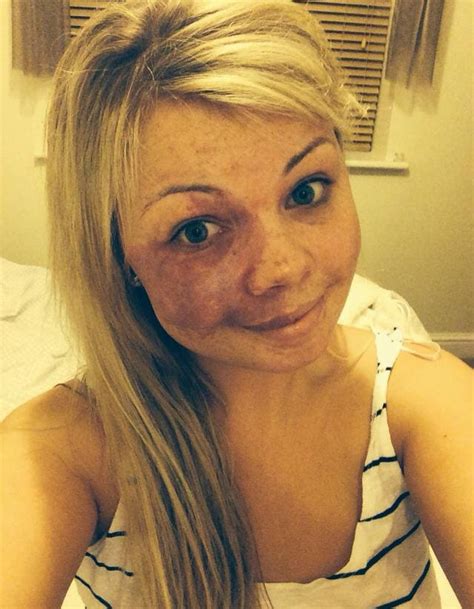 Amy Ha Una Voglia Sul Volto Ma Sfida I Bulli E Posta Un Selfie Su Fb Foto