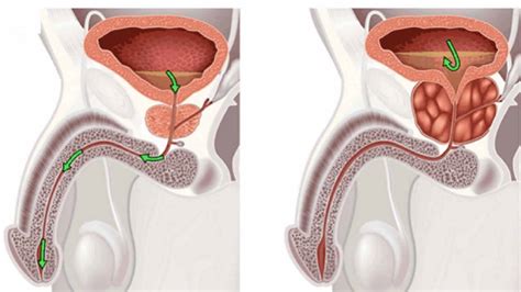 enlarged prostate signs symptoms causes diagnosis and