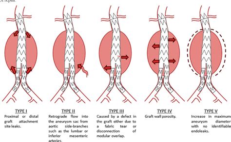 figure   endovascular aortic aneurysm repair evar semantic scholar