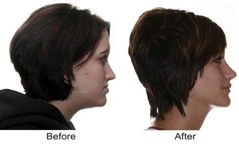 Corrective Jaw Surgery Orthognathic Reynolds Oral