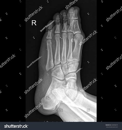 ray  foot human oblique view stock photo  shutterstock