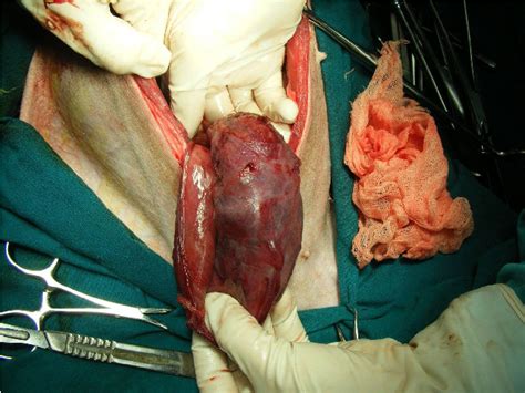 Figure 1 From Unusual Cases Of Vaginal Prolapse Concurrent With