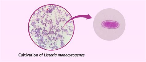 listeria monocytogenes lebensmittel
