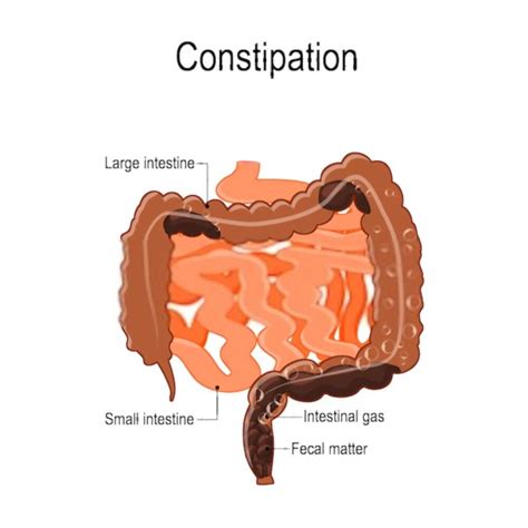 constipation  signs home remedies  treatment