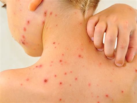 Chickenpox Decline Continues Even In Unvaccinated Groups