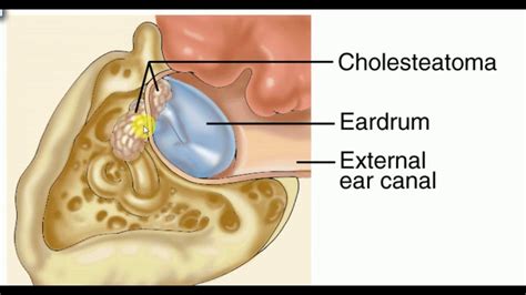 ent lectures diseases of middle ear csom fast revision youtube