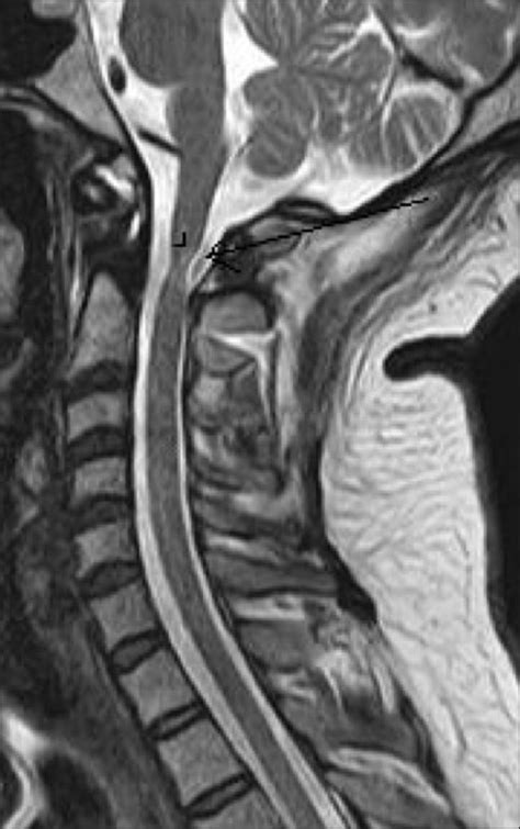 sagittal t2w mri image shows reduced caliber of the cer open i