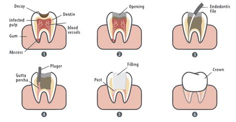 root canal claremont ca    root canal procedure