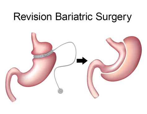 tijuana bc bariatric surgery revision continued weight loss options