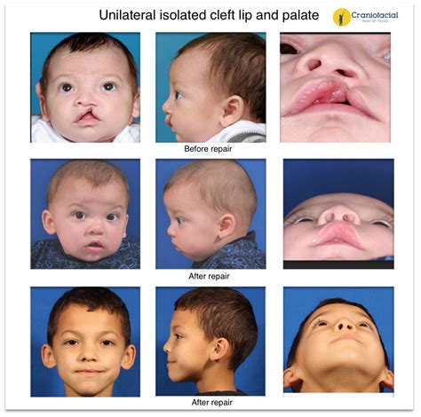 cleft lip  palate gallery earwell center  excellence