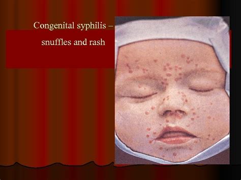 tertiary  congenital syphilis principles  therapy
