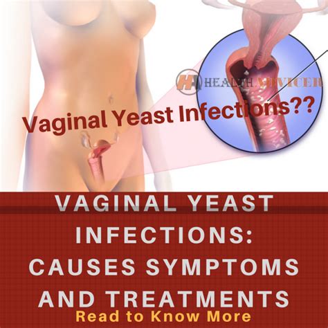 vaginal yeast infections causes pictures symptoms and