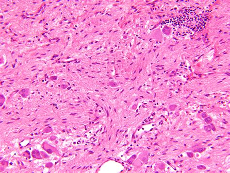 pathology outlines ganglioneuroblastoma intermixed and nodular