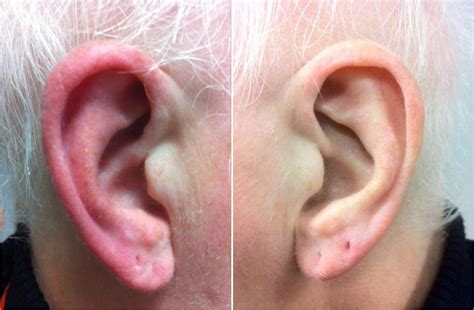 red ears symptoms   treatment