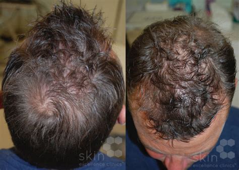 Vampire Hair Restoration Skin Excellence Clinics