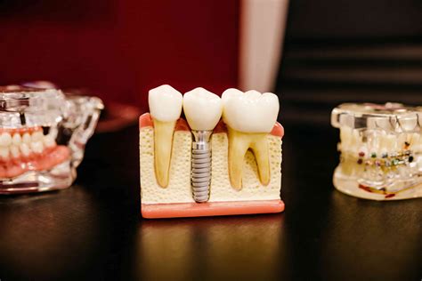 adverse effects  dental implants district dentistry