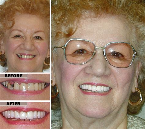 Dental Implants Vs Dentures Brooklyn Implant Dentist