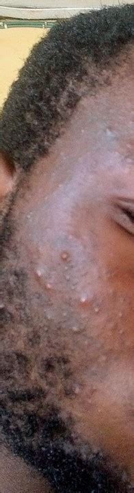 Can Neomedrol Lotion Efface The Pimples On My Face [cropped Pics