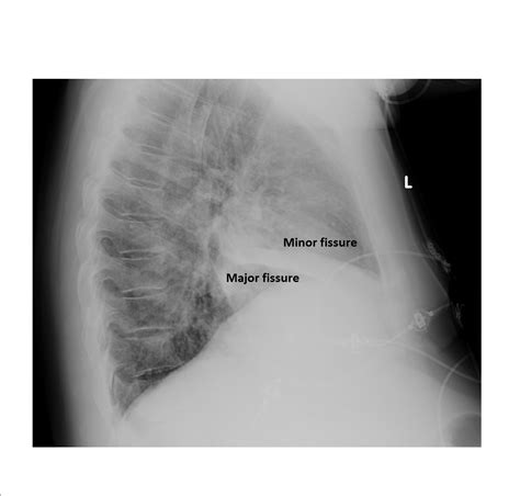 Imaging Case Of The Week 31 Emergucate