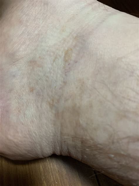 Reddish Brown Spots On On Shin And Foot Diagnoseme