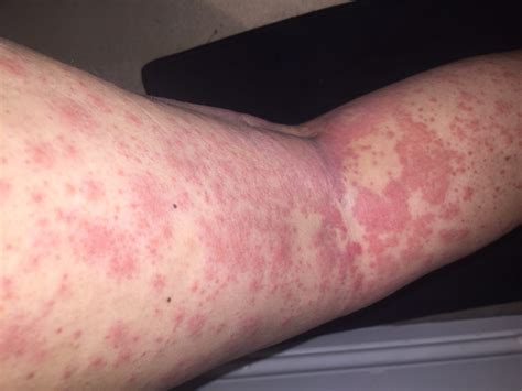 conditions  rashes  hives   page   health