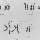 Karyotype Abnormal Chromosomes Chromosome Abnormalities Separated Tumor Neuroblastoma Prognosis sketch template