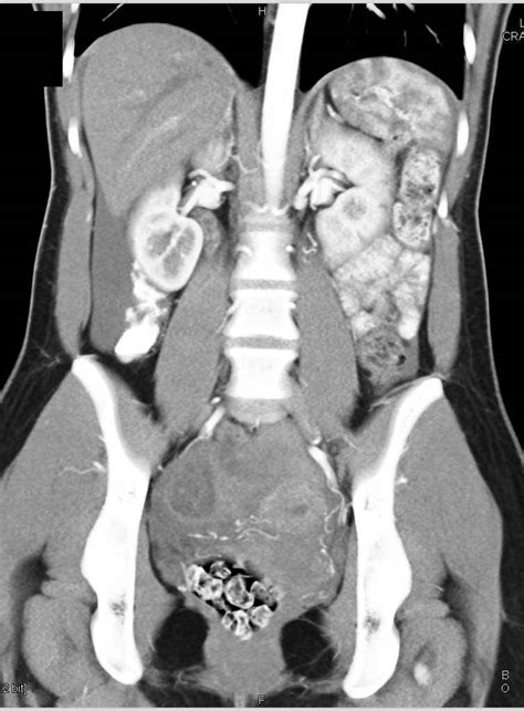 can you see ovarian cysts on a ct scan ct scan machine