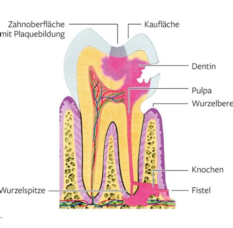 karies behandlung zahnfaeule entfernen ganz ohne bohren welt