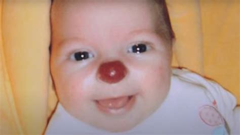 Эта девочка родилась с красным клоунским носом вот как она выглядит