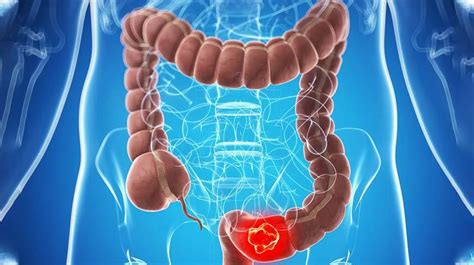 What You Need To Know About The Stages Of Colon Cancer