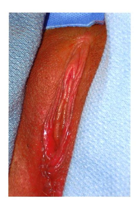 labiaplasty and labia reduction vaginoplasty in phoenix and glendale az
