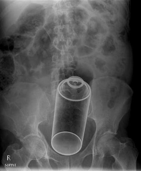 X Ray Images Reveal The Weird Things People Put In Their Butts