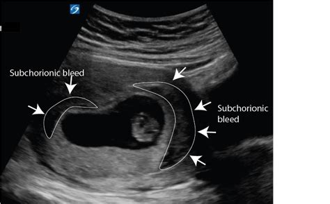 early pregnancy critical care sonography