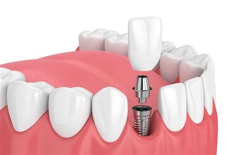 painful  dental implant surgery