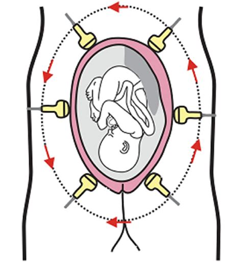 longitudinal plane  section demonstrating  fetal body  cephalic