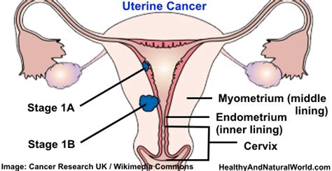 Uterine Endometrial Cancer – Symptoms Risk Factors And Prevention