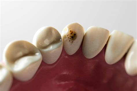 stop  cavity  worse sunbury dentists dental house