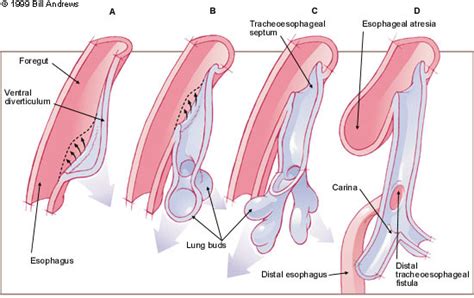 Tracheoesophageal Fistula Pediatrics Clerkship The University Of