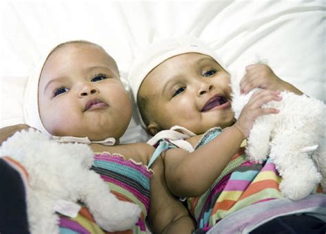 U K Surgeons Separate Twin Girls Joined At Head Cbs News