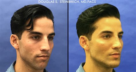 Male Model Makeover The Hottest Procedure Amongst Millennial Men New