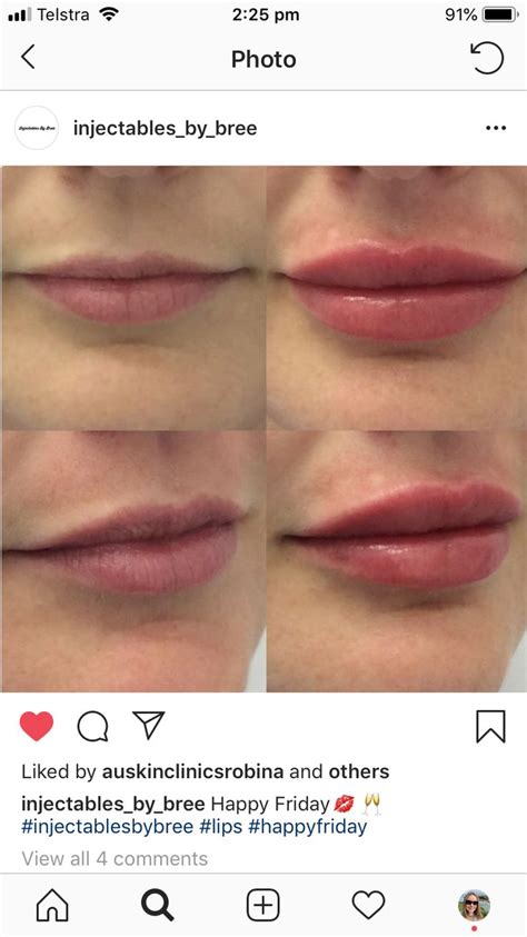 pin by janine grimes on fillers lip augmentation lips happy friday