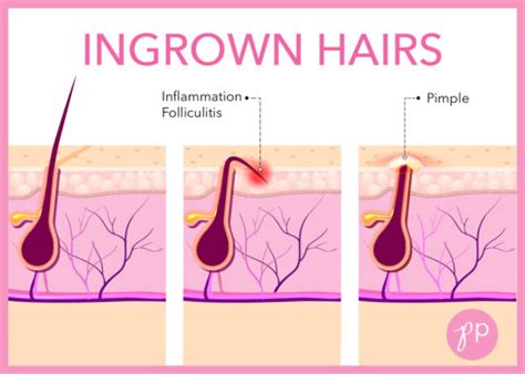 how to treat and prevent ingrown hairs the pretty pimple