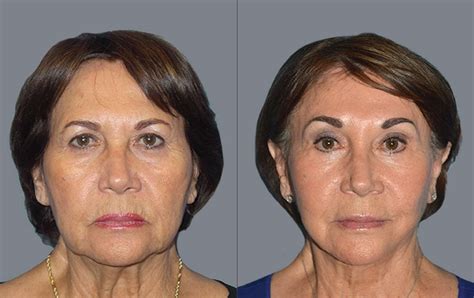 what s the best age for a facelift buckhead plastic surgery blog