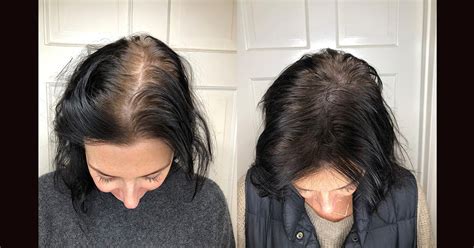 scalp micropigmentation benefits side effects   pics