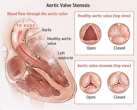 Narrowed Aortic Valve Aortic Stenosis Stenosis Heart