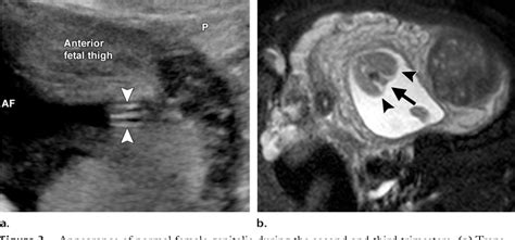 figure 3 from evaluation and management of disorders of sex development