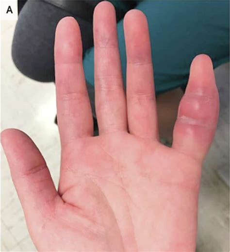 Woman S Swollen Pinky Finger Was Rare Sign Of Tuberculosis Ucsf